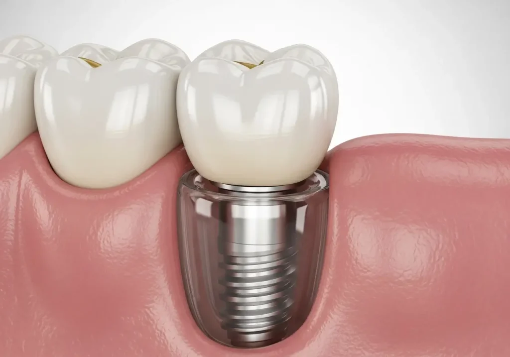 dental implant uygulamaları