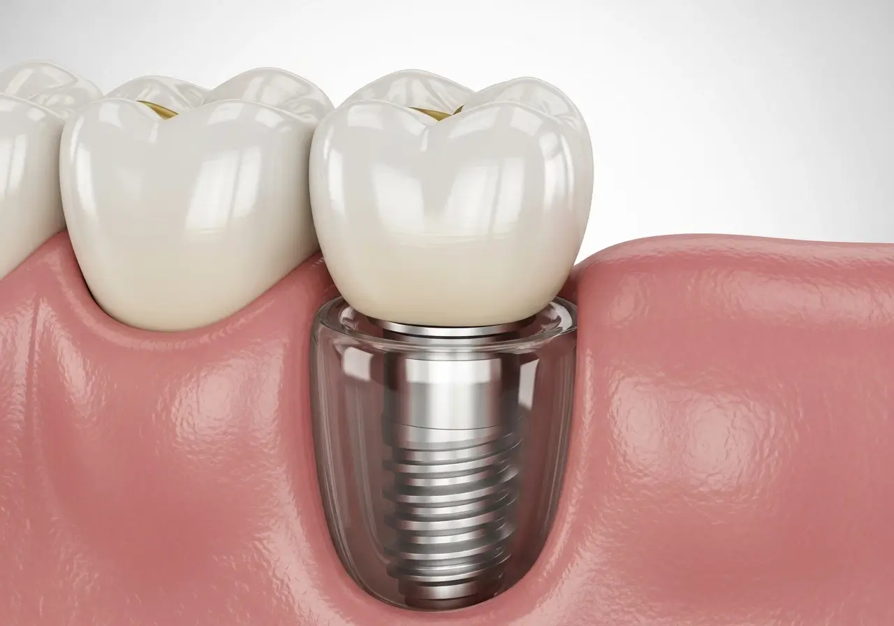 dental implant uygulamaları